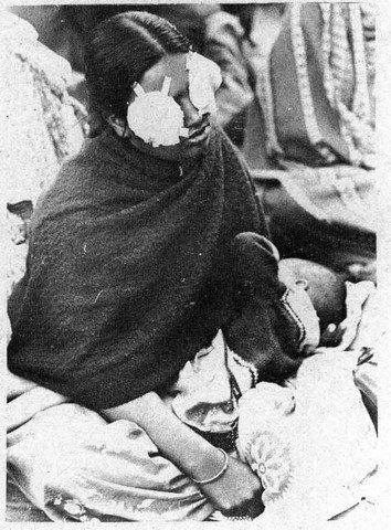 Bhopal 1984 Blinded woman nursing